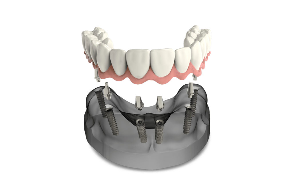 Dental Implant Cost | Ocala, FL | Dental Implants of Ocala