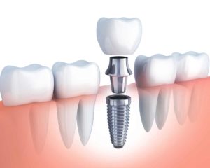 Diagram of a dental implant.