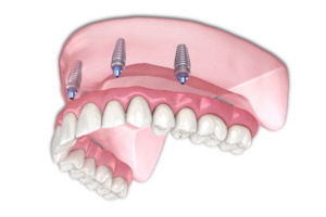 all on 4 dental implants by Bushnell, FL.