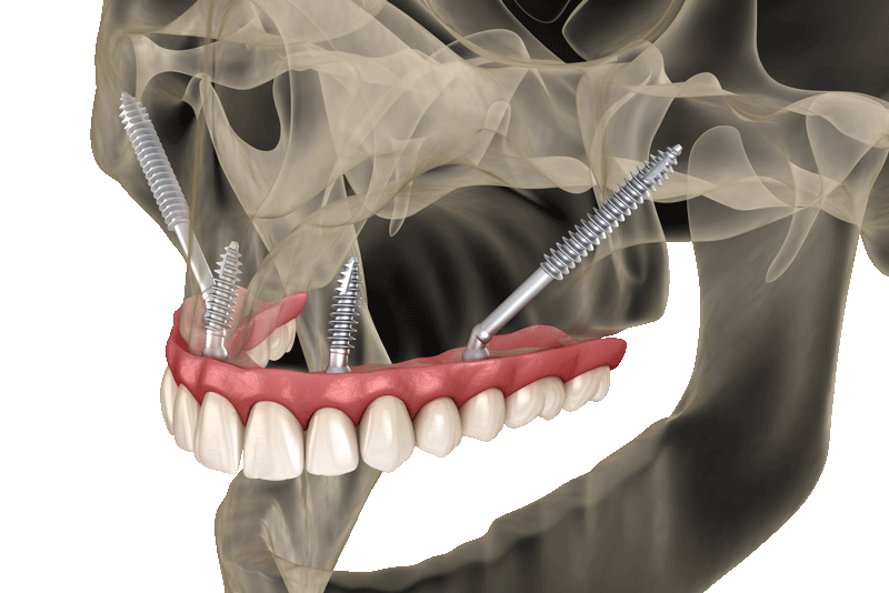 Zygomatic Dental Implant All On 4 Implants Full Arch