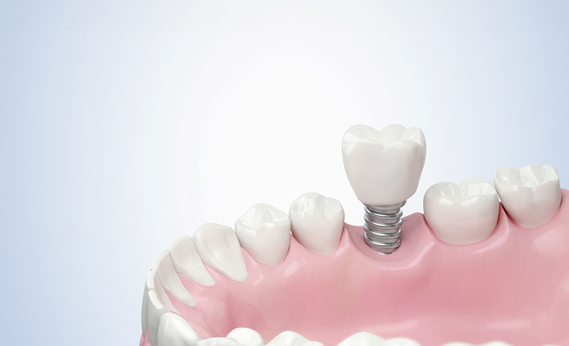 A close-up of a dental implant model showing a white tooth and pink gums illustrates the integration of a dental implant into the jaw for medical education.