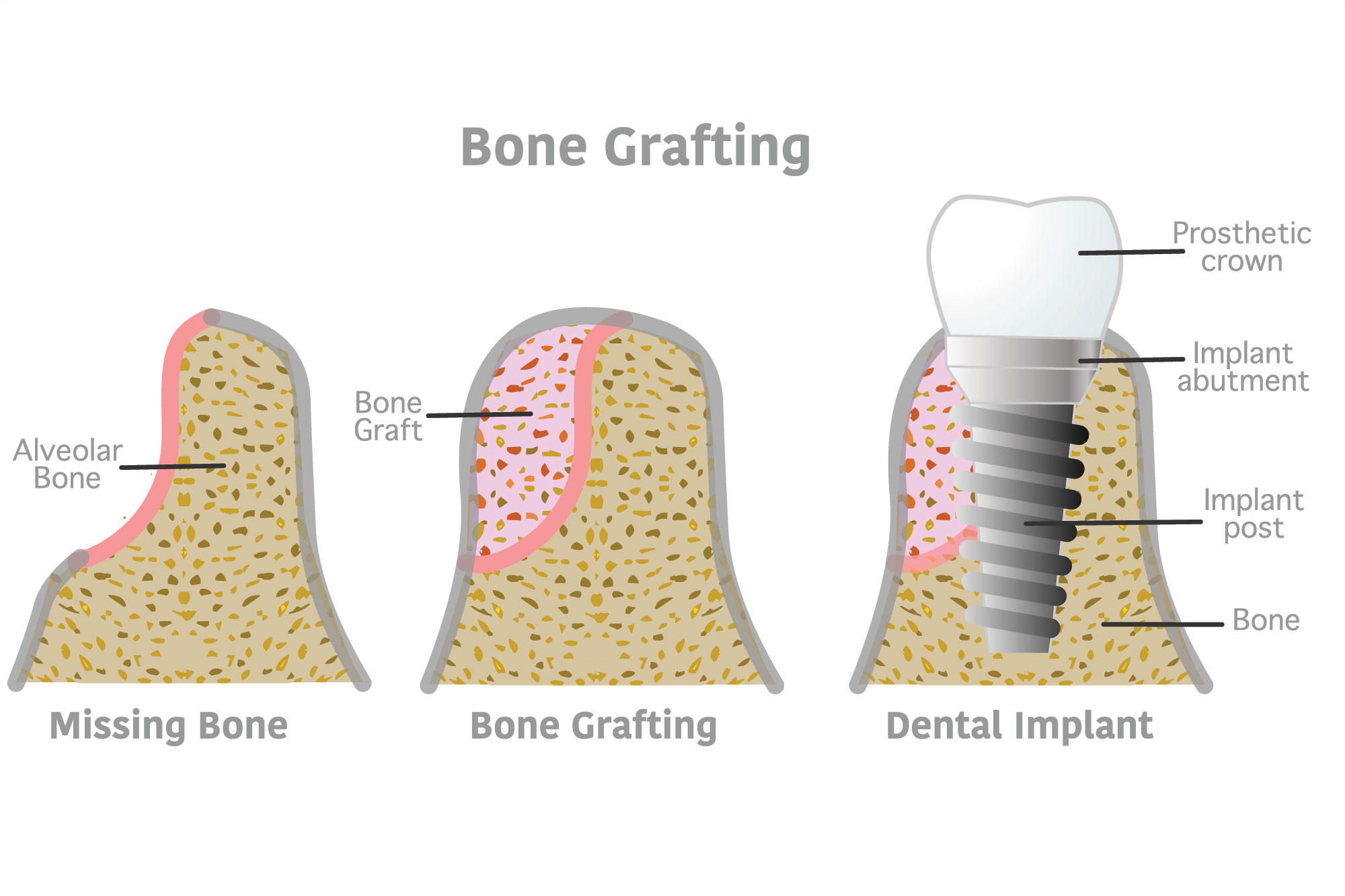 bone grafting diagram showing the restorative process